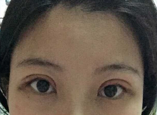 北京八大处王太玲做双眼皮果怎么样?