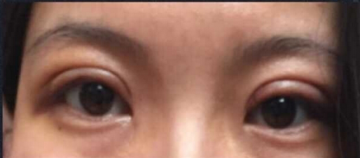 北京八大处王太玲做双眼皮果怎么样?