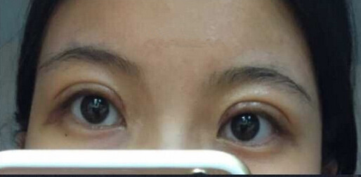 北京八大处王太玲做双眼皮果怎么样?