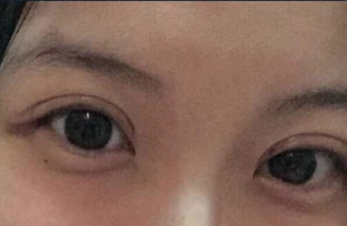 北京八大处王太玲做双眼皮果怎么样?