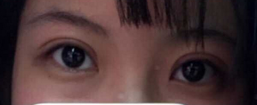 北京八大处王太玲做双眼皮果怎么样?