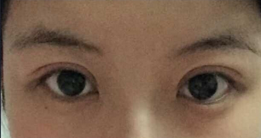 北京八大处王太玲做双眼皮果怎么样?