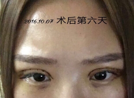 上海九院王业飞医生做的双眼皮手术果