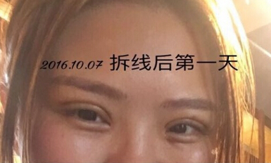 上海九院王业飞医生做的双眼皮手术果