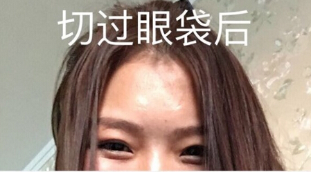 上海九院王业飞医生做的双眼皮手术果