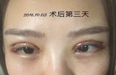 上海九院王业飞医生做的双眼皮手术果