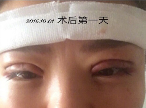 上海九院王业飞医生做的双眼皮手术果