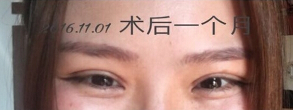 上海九院王业飞医生做的双眼皮手术果