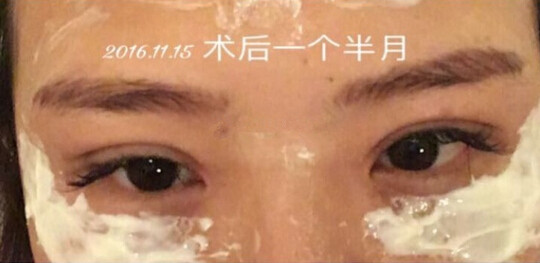 上海九院王业飞医生做的双眼皮手术果