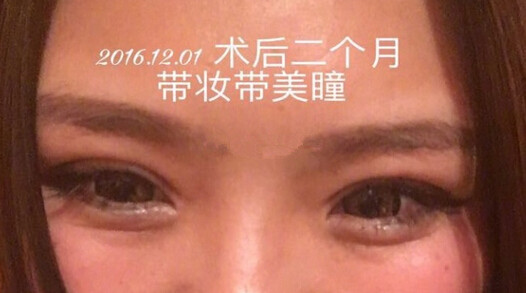 上海九院王业飞医生做的双眼皮手术果