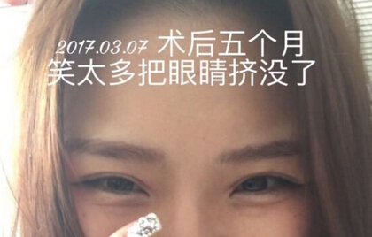 上海九院王业飞医生做的双眼皮手术果