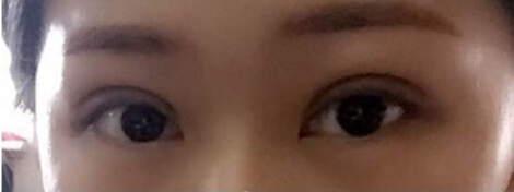 清华大学玉泉医院尹主任做的双眼皮果