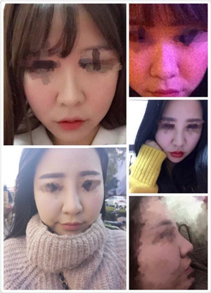 扬州艺星美陶院做的双眼皮鼻部手术