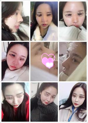 扬州艺星美陶院做的双眼皮鼻部手术