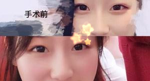 合肥华美赵院做的双眼皮鼻部手术果