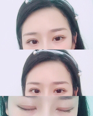 合肥华美赵院做的双眼皮鼻部手术果
