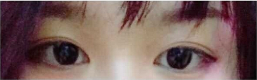 上海九院黄如林医生做的双眼皮开眼角