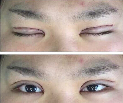 上海九院黄如林医生做的双眼皮开眼角