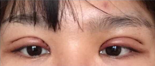 上海九院黄如林医生做的双眼皮开眼角