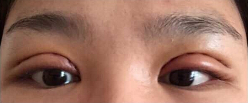 上海九院黄如林医生做的双眼皮开眼角