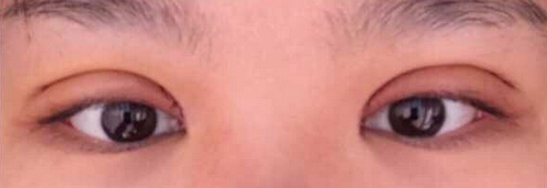 上海九院黄如林医生做的双眼皮开眼角