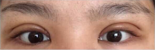 上海九院黄如林医生做的双眼皮开眼角
