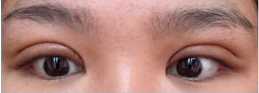 上海九院黄如林医生做的双眼皮开眼角