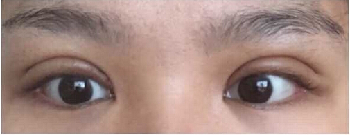 上海九院黄如林医生做的双眼皮开眼角