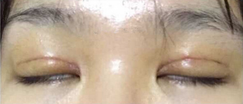 上海九院黄如林医生做的双眼皮开眼角