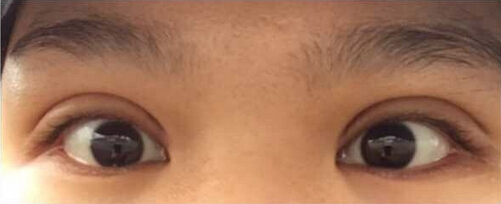 上海九院黄如林医生做的双眼皮开眼角