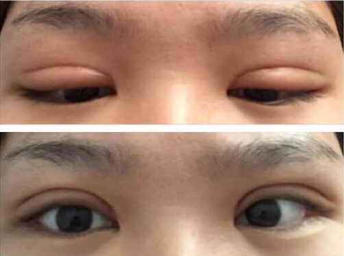 上海九院黄如林医生做的双眼皮开眼角