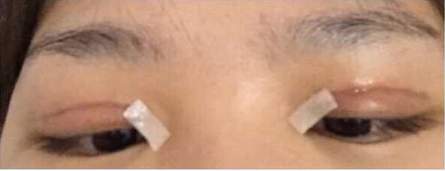 上海九院黄如林医生做的双眼皮开眼角