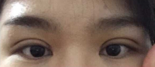 上海九院黄如林医生做的双眼皮开眼角