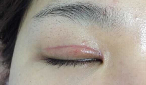 上海九院黄如林医生做的双眼皮开眼角