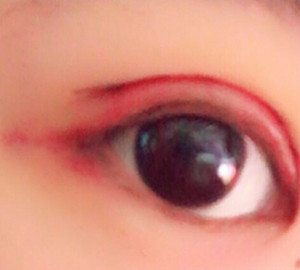 上海九院周一雄医生做的双眼皮果