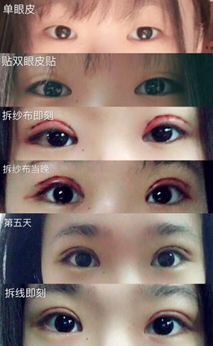 上海九院周一雄医生做的双眼皮果