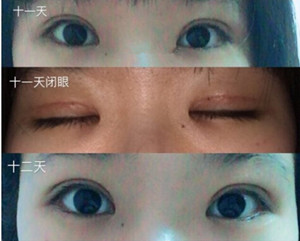 上海九院周一雄医生做的双眼皮果