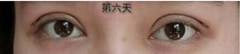 长沙申美俞医生做是双眼皮提肌手术