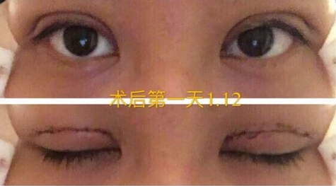 整形医院吕方中做双眼皮果好吗?