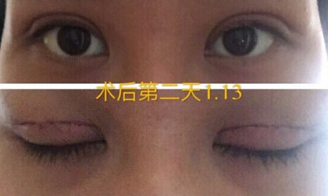 整形医院吕方中做双眼皮果好吗?