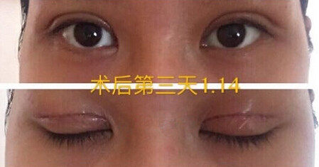 整形医院吕方中做双眼皮果好吗?
