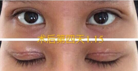 整形医院吕方中做双眼皮果好吗?