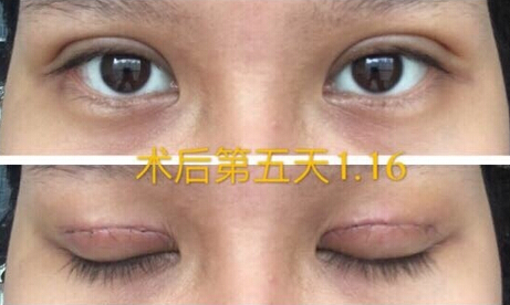 整形医院吕方中做双眼皮果好吗?