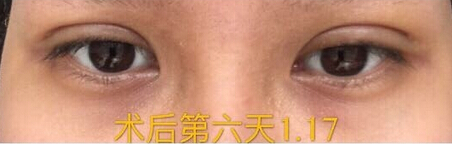 整形医院吕方中做双眼皮果好吗?