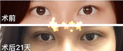 整形医院吕方中做双眼皮果好吗?