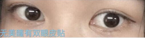 整形医院吕方中做双眼皮果好吗?