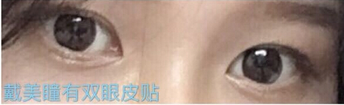 整形医院吕方中做双眼皮果好吗?