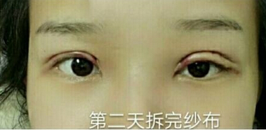 北京八大处靳小雷医生做的全切双眼皮手术