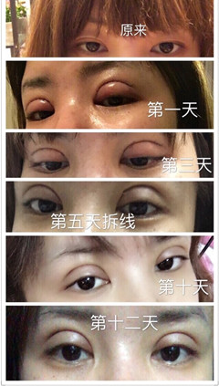 北京八大处石蕾医生做的双眼皮手术果