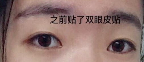 秦皇岛做的双眼皮右眼角肿了一块怎么回事?